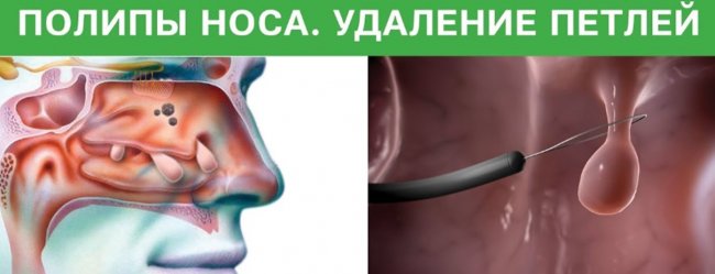 удаление полипов в носу в Москве цены