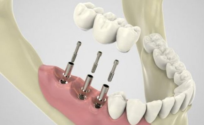Протезирование зубов: о чем важно узнать