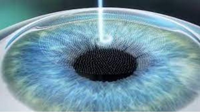 Лазерная коррекция Супер Ласик – операция на глазах