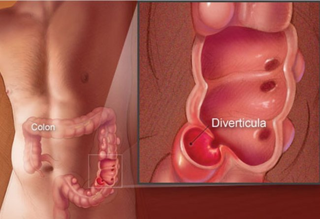 Дивертикулит: как избавиться от наростов на стенках кишечника