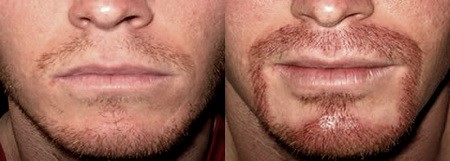 Популярные методы и особенности пересадки волос на лицо