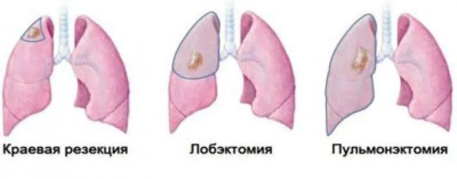 Операция лобэктомия лёгкого: как вернуть дыхание без боли
