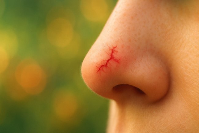 Что делать, если лопнул капилляр на носу и как помогает «умный» лазер